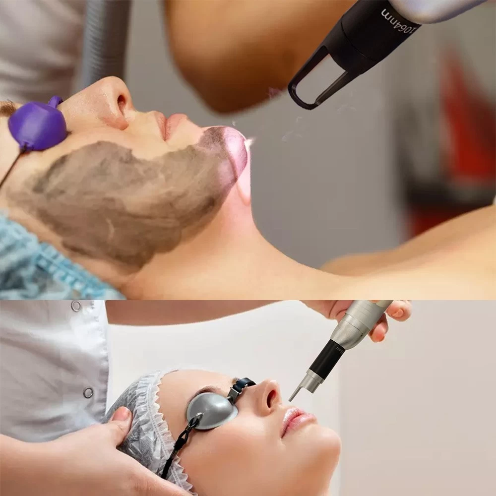 YAG laser